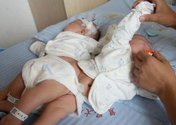 連體嬰兒是怎么形成的.png 連體嬰兒是怎么形成的.png