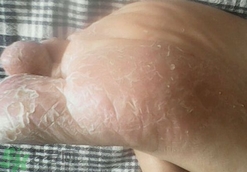 夏天腳脫皮用什么藥?夏天腳脫皮用什么泡腳? 夏天腳脫皮用什么藥?夏天腳脫皮用什么泡腳?