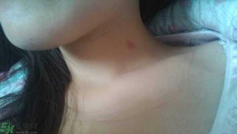 種草莓吻痕是什么意思？吻痕是怎么弄出來的？