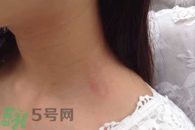 種草莓吻痕是什么意思？吻痕是怎么弄出來的？