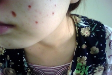 激光點(diǎn)痣后可以洗臉嗎？激光點(diǎn)痣后需要注意什么？