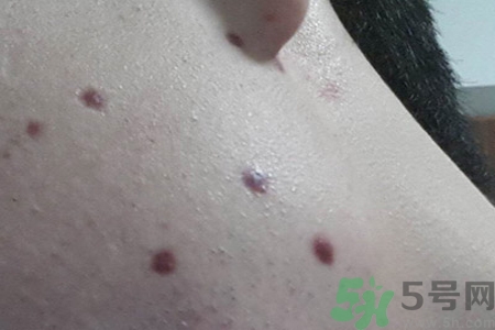 激光點(diǎn)痣后可以洗臉嗎？激光點(diǎn)痣后需要注意什么？