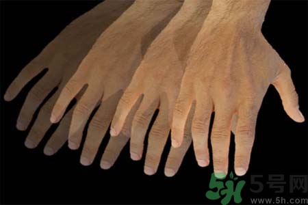 帕金森的易發(fā)人群有哪些？如何預防帕金森？