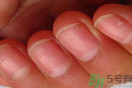 手指甲凹凸不平是怎么回事？如何預(yù)防手指甲凹凸不平？