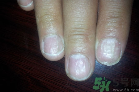 手指甲凹凸不平是怎么回事？如何預(yù)防手指甲凹凸不平？