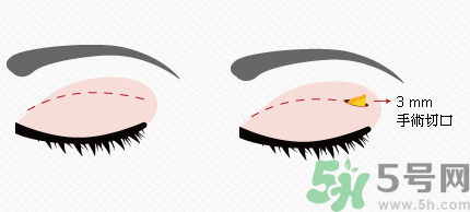 提眉術(shù)后多久可以恢復(fù)？提眉術(shù)后全過(guò)程照片