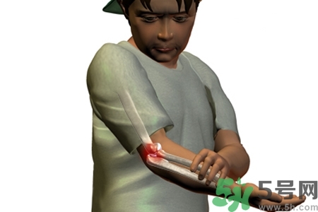 幼年關(guān)節(jié)炎的好發(fā)年齡？幼年關(guān)節(jié)炎別輕易忽視