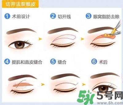 雙眼皮手術哪種最好？割雙眼皮后注意些什么？