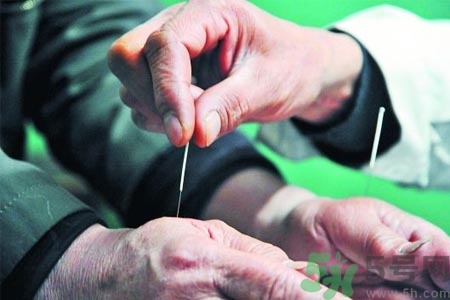 針灸一次要扎多長時間？針灸可以幾天做一次？