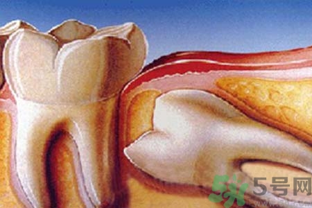 智齒拔完后有個(gè)洞怎么辦？拔智齒后有個(gè)洞多久能長(zhǎng)好？