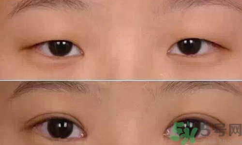 天生腫眼泡怎么消除？天生腫眼泡怎么辦？