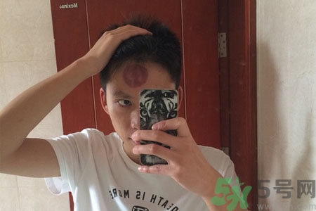 頭痛可以在額頭上拔火罐嗎？額頭上拔火罐有什么好處？