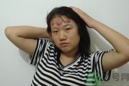 頭痛可以在額頭上拔火罐嗎？額頭上拔火罐有什么好處？