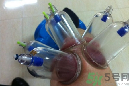 膝蓋能拔罐嗎？膝蓋疼可以拔罐嗎？