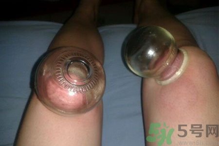 膝蓋能拔罐嗎？膝蓋疼可以拔罐嗎？