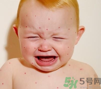 新生兒濕疹怎么引起的？新生兒濕疹如何處理？