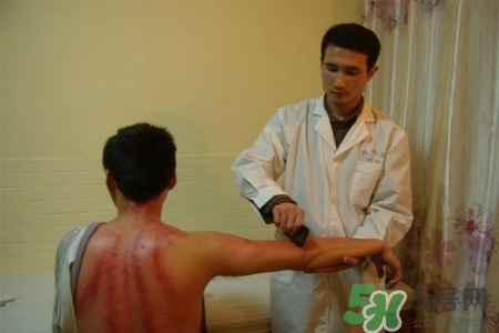 刮痧能去濕氣嗎？去濕氣是拔罐好還是刮痧好？