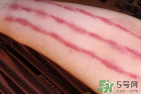 揪痧是什么？揪痧的好處有哪些？