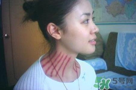 揪痧是什么？揪痧的好處有哪些？