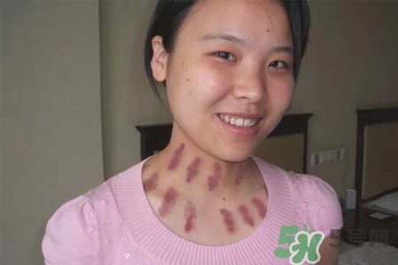 揪痧是什么？揪痧的好處有哪些？