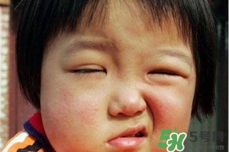 拔牙會(huì)導(dǎo)致面癱嗎?？拔牙為什么會(huì)導(dǎo)致面癱？