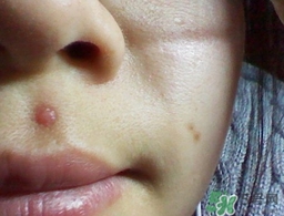 激光點痣會留疤嗎?激光點痣會留坑嗎? 激光點痣會留疤嗎?激光點痣會留坑嗎?