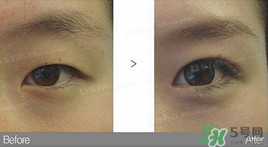 埋線雙眼皮需要拆線嗎？埋線雙眼皮怎么拆線