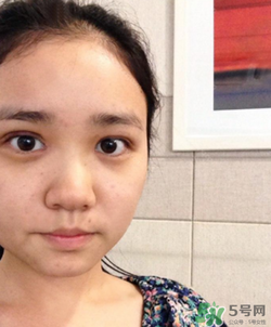 埋線雙眼皮的危害_埋線雙眼皮有風(fēng)險后遺癥嗎 埋線雙眼皮的危害_埋線雙眼皮有風(fēng)險后遺癥嗎