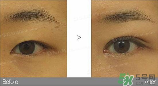 埋線雙眼皮需要拆線嗎？埋線雙眼皮怎么拆線