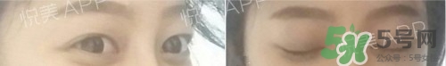 埋線雙眼皮多久恢復(fù)自然？埋線雙眼皮多久能恢復(fù)