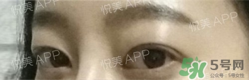 埋線雙眼皮多久恢復(fù)自然？埋線雙眼皮多久能恢復(fù)