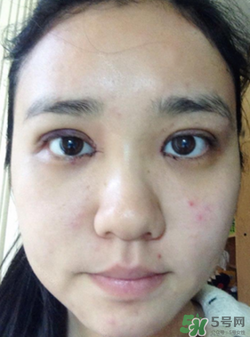 埋線雙眼皮的危害_埋線雙眼皮有風(fēng)險后遺癥嗎 埋線雙眼皮的危害_埋線雙眼皮有風(fēng)險后遺癥嗎