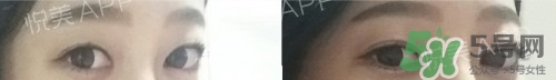 埋線雙眼皮多久恢復(fù)自然？埋線雙眼皮多久能恢復(fù)