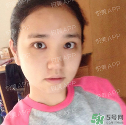 埋線雙眼皮的危害_埋線雙眼皮有風(fēng)險后遺癥嗎 埋線雙眼皮的危害_埋線雙眼皮有風(fēng)險后遺癥嗎