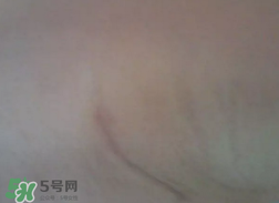 假體隆胸取出后悔死了 假體隆胸取出后圖片 假體隆胸取出后悔死了 假體隆胸取出后圖片