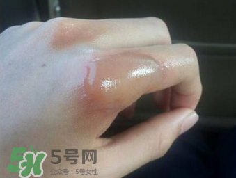 燙傷可以用牙膏嗎？燙傷用牙膏管用嗎？