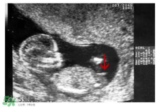 NT超圖全景看寶寶性別，親證有效的B超自測(cè)男女方法