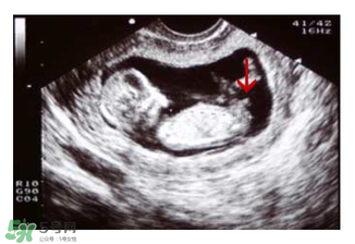 NT超圖全景看寶寶性別，親證有效的B超自測(cè)男女方法