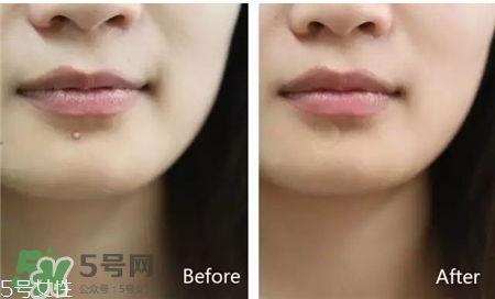 樂(lè)膚潔的痘痘貼好用么?樂(lè)膚潔凈痘貼怎么樣? 樂(lè)膚潔的痘痘貼好用么?樂(lè)膚潔凈痘貼怎么樣?