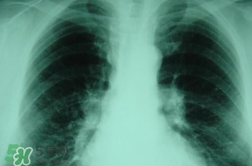 塵肺病吃什么藥能清肺？塵肺病國家有什么政策