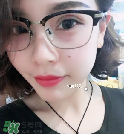 三點(diǎn)定位雙眼皮過程圖 做三點(diǎn)定位雙眼皮心得 三點(diǎn)定位雙眼皮過程圖 做三點(diǎn)定位雙眼皮心得