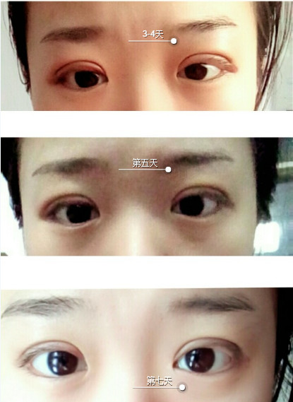 三點定位雙眼皮永久嗎 三點定位雙眼皮恢復(fù)過程圖片 三點定位雙眼皮永久嗎 三點定位雙眼皮恢復(fù)過程圖片