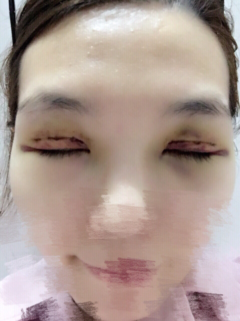 三點定位雙眼皮永久嗎 三點定位雙眼皮恢復(fù)過程圖片 三點定位雙眼皮永久嗎 三點定位雙眼皮恢復(fù)過程圖片