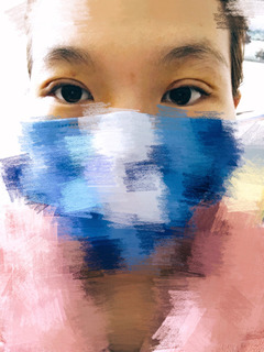 三點定位雙眼皮永久嗎 三點定位雙眼皮恢復(fù)過程圖片 三點定位雙眼皮永久嗎 三點定位雙眼皮恢復(fù)過程圖片