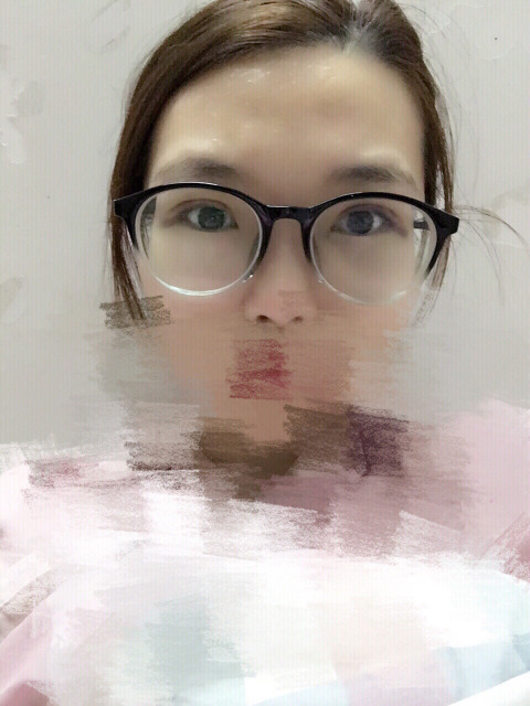 三點定位雙眼皮永久嗎 三點定位雙眼皮恢復(fù)過程圖片 三點定位雙眼皮永久嗎 三點定位雙眼皮恢復(fù)過程圖片