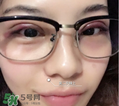 三點(diǎn)定位雙眼皮過程圖 做三點(diǎn)定位雙眼皮心得 三點(diǎn)定位雙眼皮過程圖 做三點(diǎn)定位雙眼皮心得