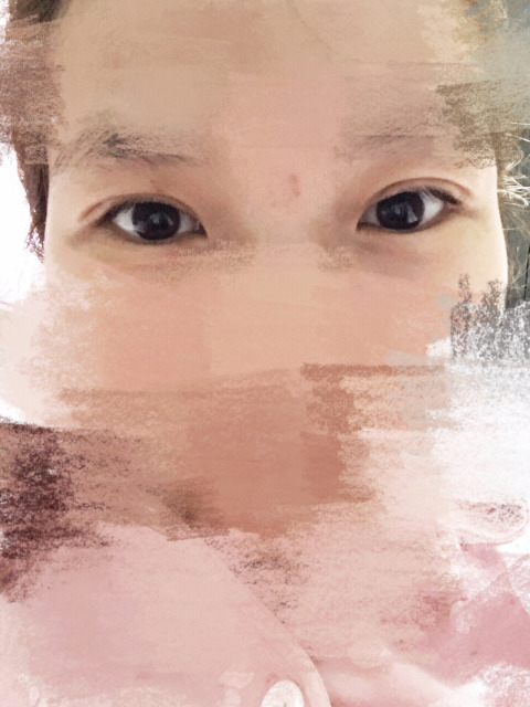 三點定位雙眼皮永久嗎 三點定位雙眼皮恢復(fù)過程圖片 三點定位雙眼皮永久嗎 三點定位雙眼皮恢復(fù)過程圖片