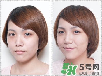 淚溝怎么祛除?淚溝的祛除 淚溝怎么祛除?淚溝的祛除