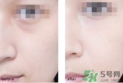 淚溝能自己恢復(fù)嗎？淚溝怎么自己恢復(fù)？