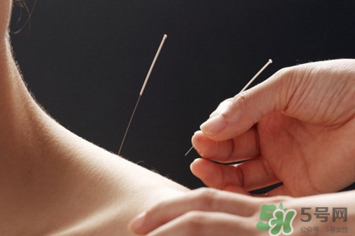 針灸可以天天扎嗎？針灸可以每天扎嗎